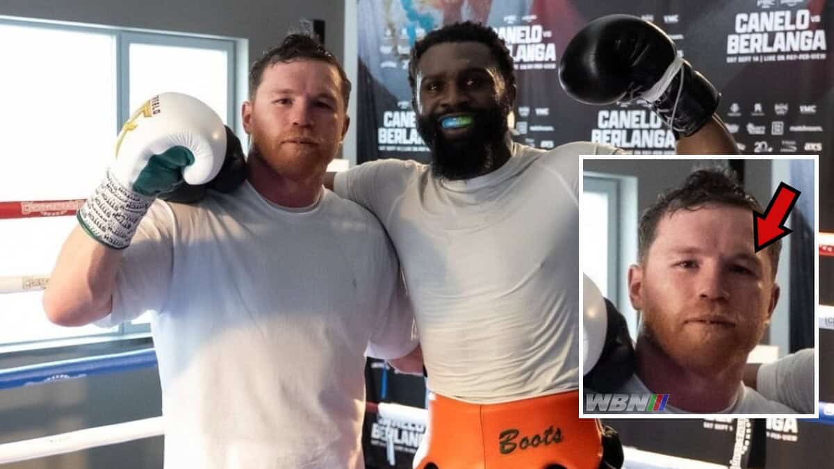 Canelo Ennis black eye