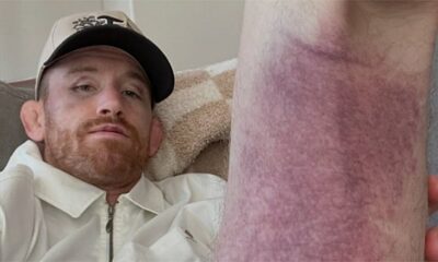 Cory Sandhagen details brutal hamstring injury suffered in UFC 329 loss