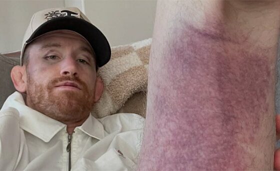 Cory Sandhagen details brutal hamstring injury suffered in UFC 329 loss