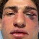 Austin Bashi reveals facial fractures following UFC OKC loss