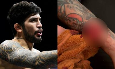 GRAPHIC | Dillon Danis shares nasty aftermath of injury that forced Mike Perry fight withdrawal